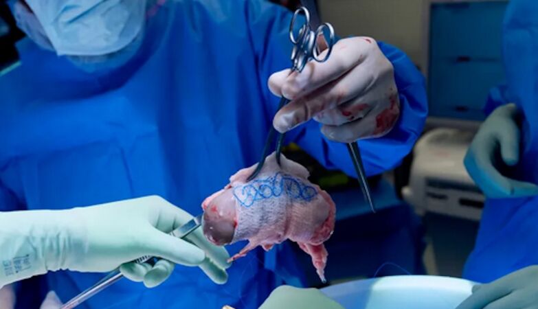 “Compatibility was one in a million”: North American woman receives pig kidney transplant