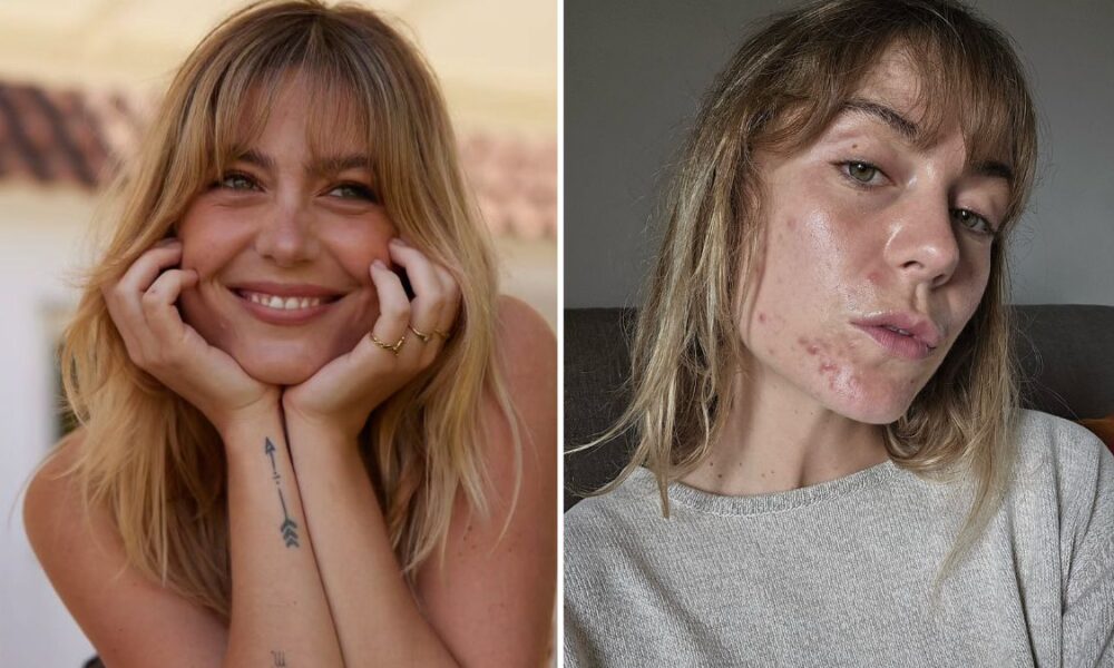 Ana Marta Ferreira faz tratamento e mostra ‘antes’ e ‘depois’: “Nunca pensei…”