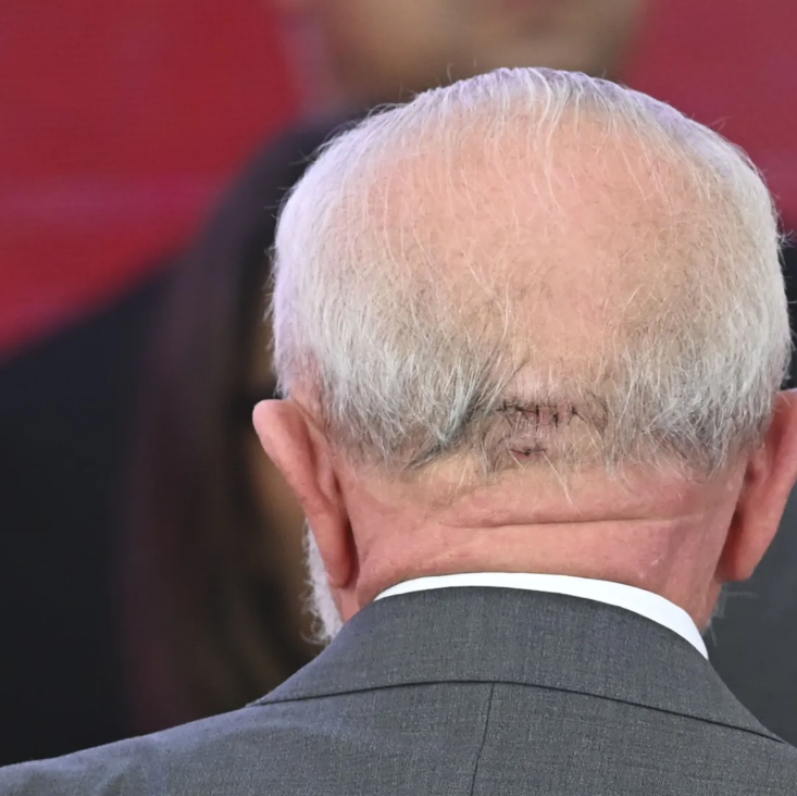 Lula is rushed into surgery in São Paulo after feeling pain in his head