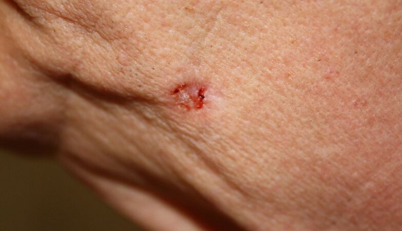 Portuguese help to find out how it is formed and develops the most common skin cancer