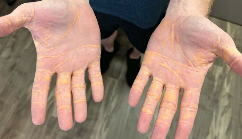 North American left with yellow lumps on hands and feet after adopting a carnivorous diet