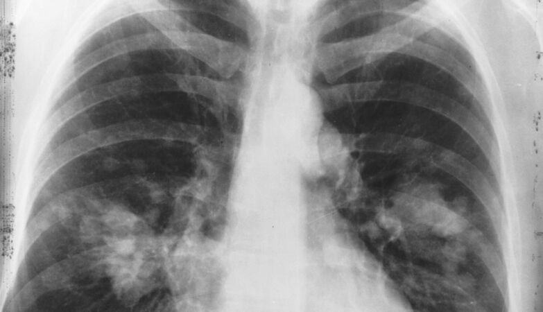 The lung is a frequent organ of metastasis (and we already know why)