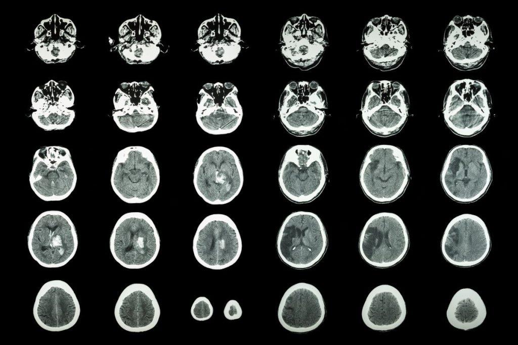 The relationship between stress and stroke cases: myth or reality