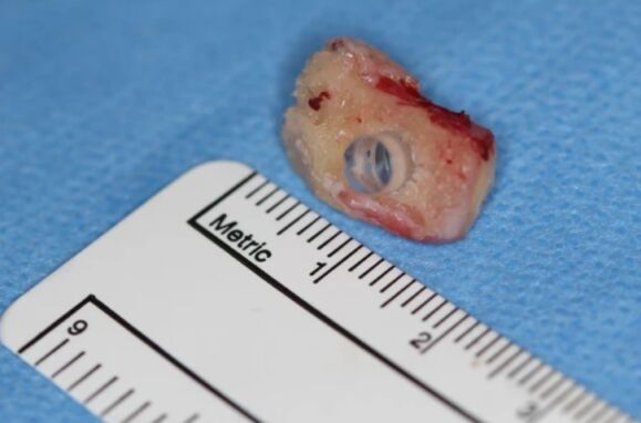 Vision of three patients recovered with… eye tooth implants