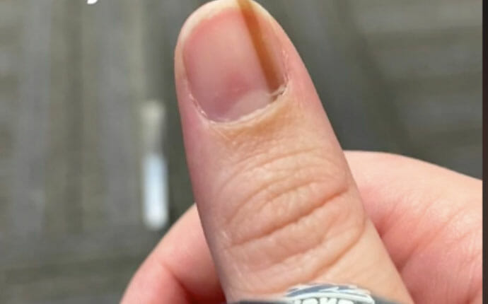 Line on the nail: What does it mean and when do I need to worry?