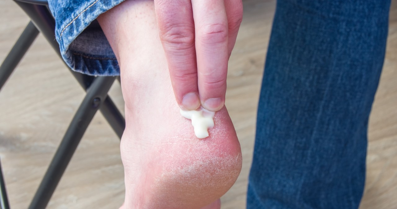 This ointment from the pharmacy smoothes damaged heels. Just in time for sandals