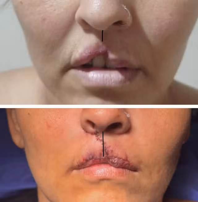 'Happy with the result', says a woman who had lip torn by dog and had 1st repairing surgery