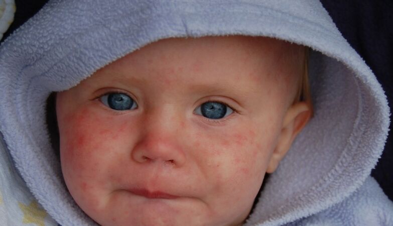 Measles: Cases multiply in Europe. Portugal is exception