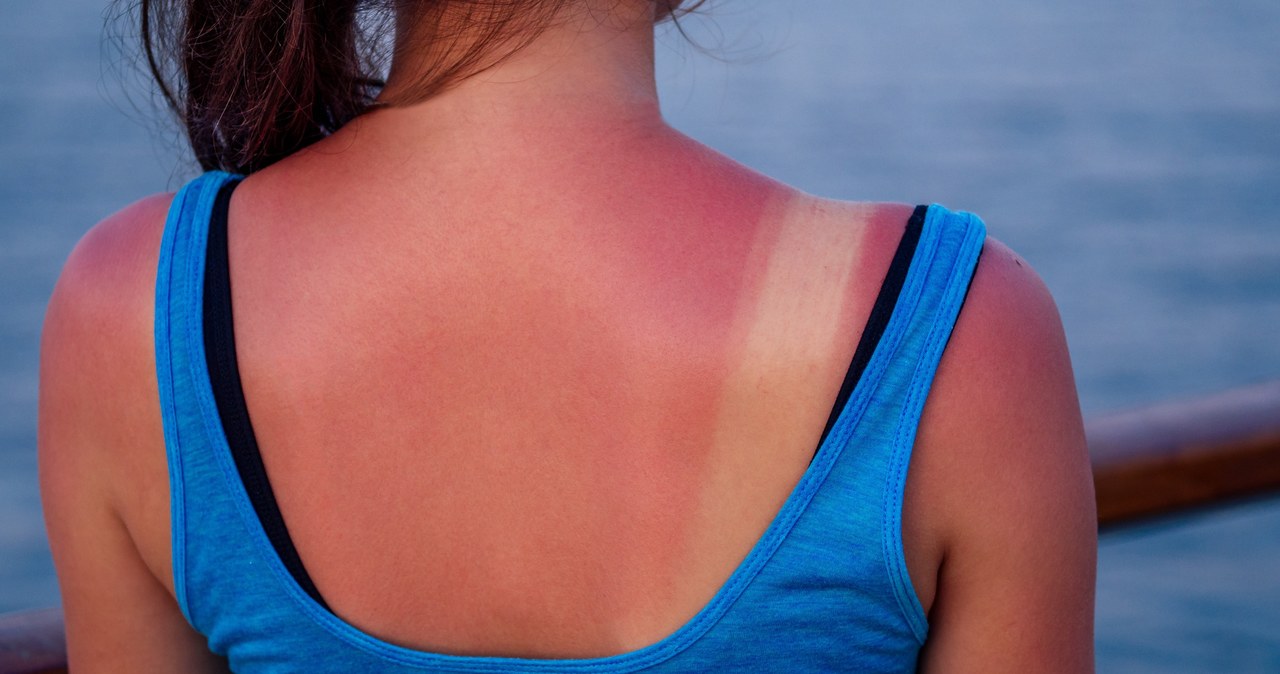 Sunburn can be very painful /123RF /PICSEL