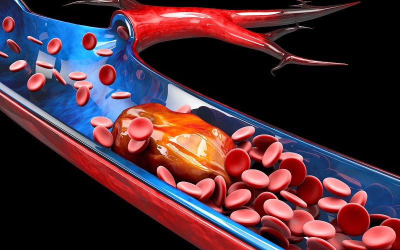 How to Find out if a blood clot was formed: 7 warning signs