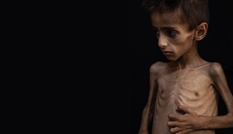 Osama, 5 years, 9 pounds. The face of a generation that will have serious health problems for life