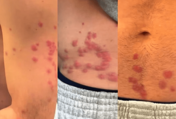 Brazilian activist shows marks of aggression after being detained in Israel