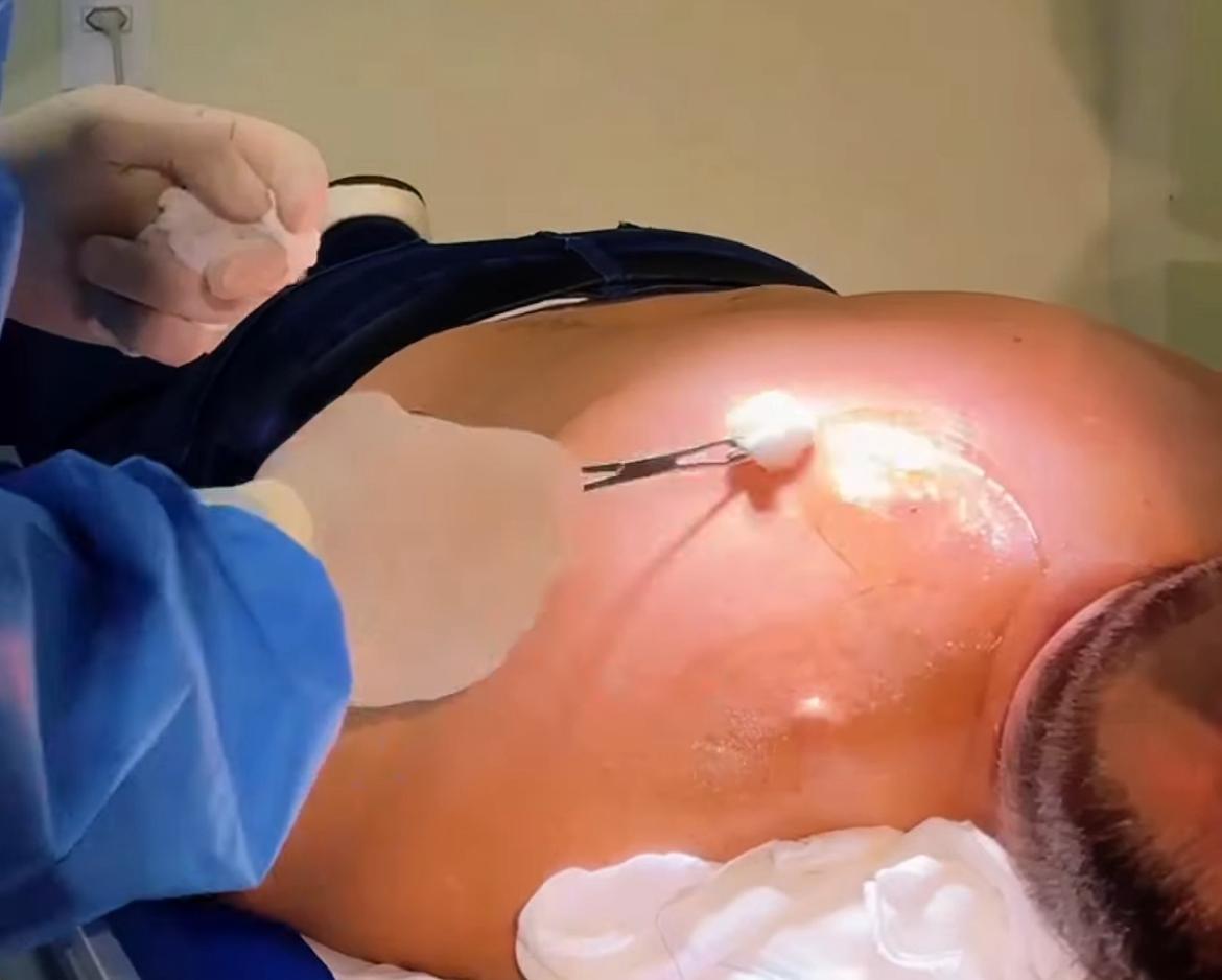 Bocalom undergoes surgery for cyst removal and shows the procedure; LOOK