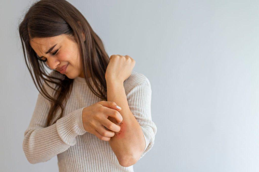 Has eczema always reddened?