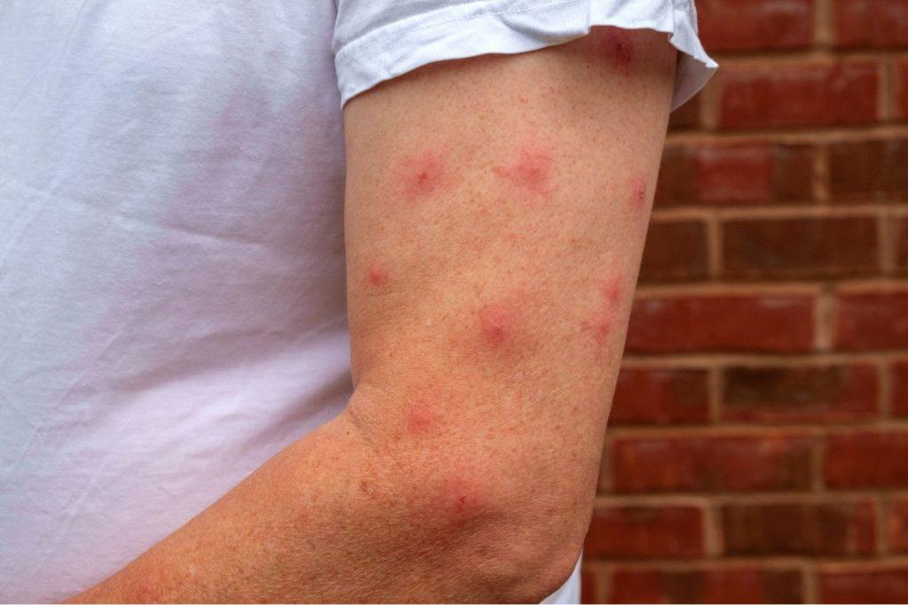 First aid after insect bites