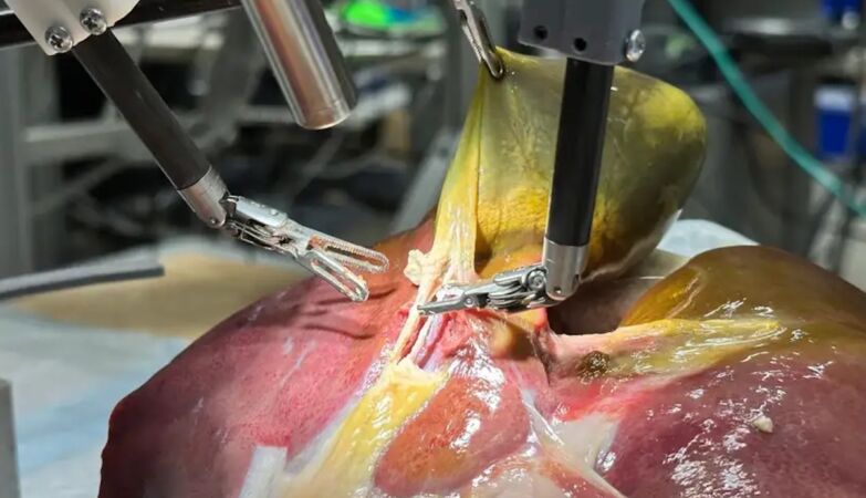 Successfully completed the first 100% surgery made by a robot
