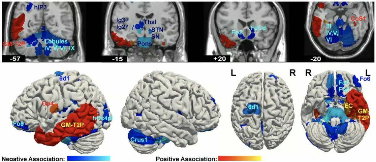 How does the brain of a psychopath work?
