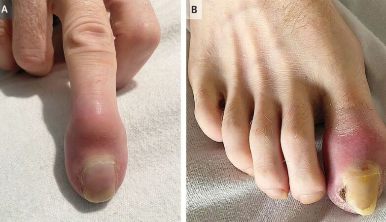 He had a strange swelling on his fingers. It was a symptom of cancer in the advanced lung