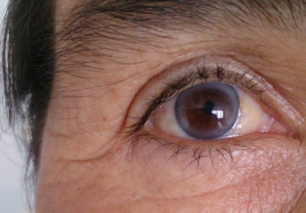 10 things our eyes can say about health