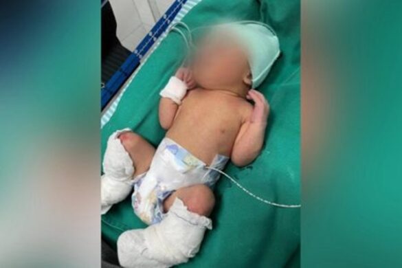 Health confirms that baby aurora suffered 2nd and 3rd degrees burns during bath
