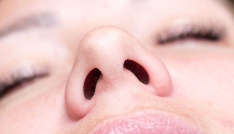 Woman gets “empty nose syndrome” after surgery. What is this syndrome?