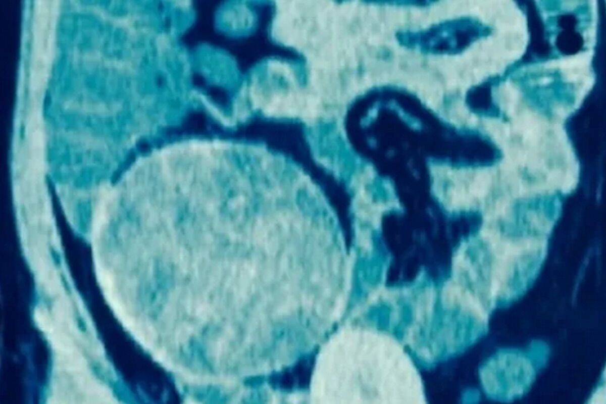 Strange lump in a woman's hip was forgotten sponge during caesarean section
