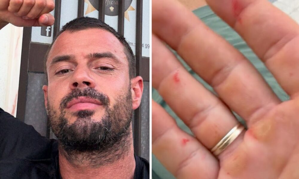 Marco Costa mostra les&otilde;es ap&oacute;s ‘acidente’ no trabalho: “Pus a m&atilde;o dentro do tacho…”