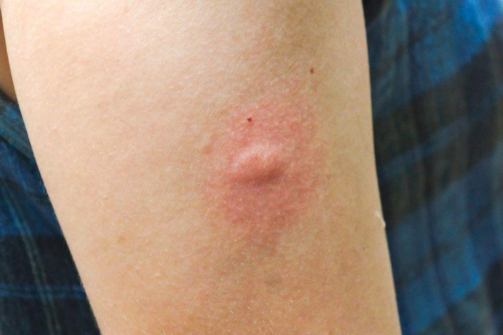 Insect bites in the summer: how to recognize and respond appropriately