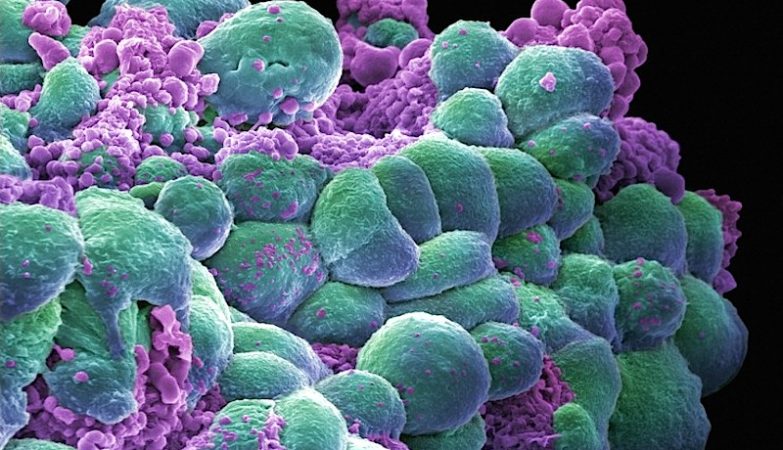 Flu and Covid can arouse numb cells from the breast cancer
