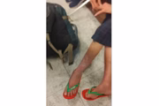 French was hospitalized with thrombosis
