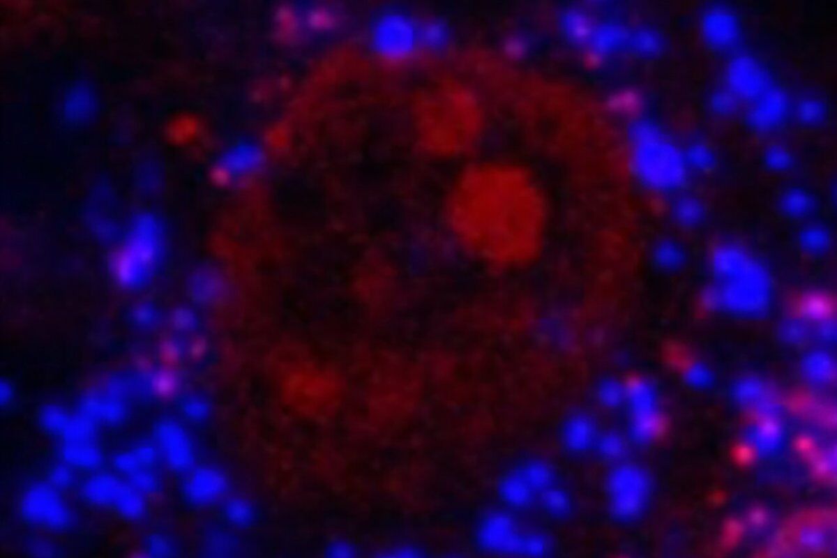 “Worrying”: microplastics found inside human bones