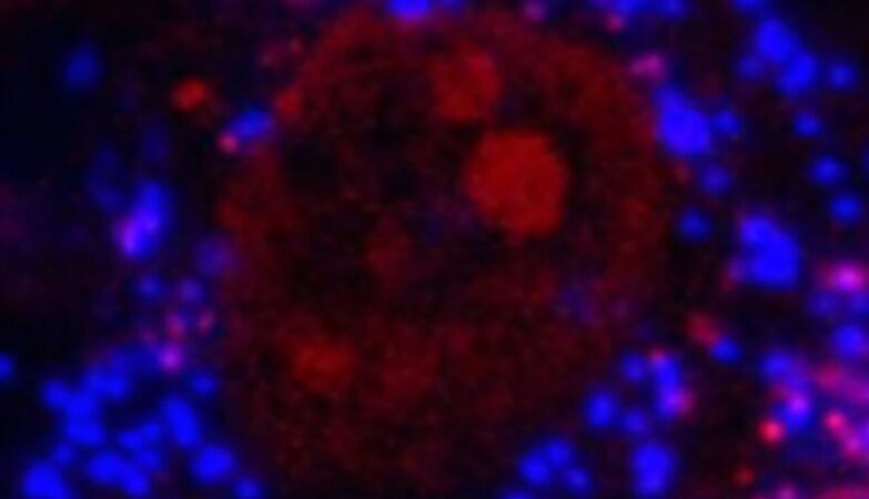 “Worrying”: microplastics found inside human bones