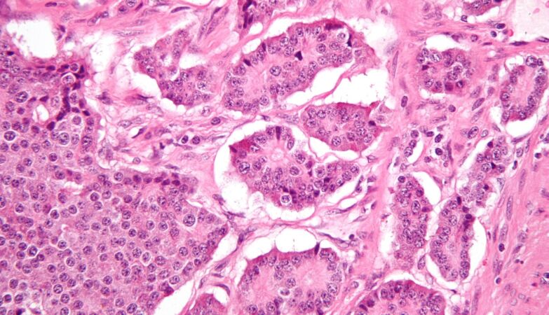 Developed in Portugal “highly effective” therapy against aggressive tumors