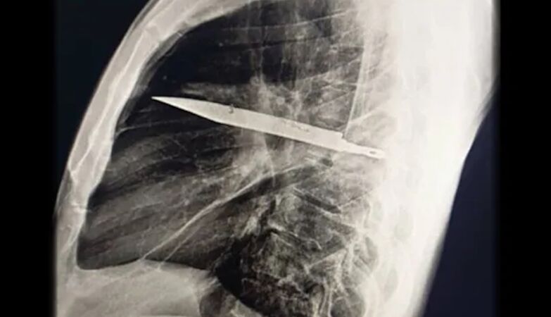 Lived 8 years with the blade of a knife spotted in the chest - and did not know