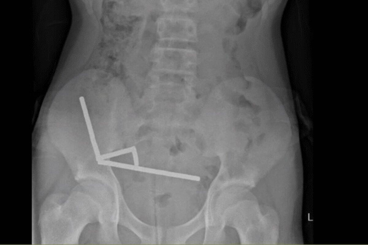 Young New Zealander swallowed 200 magnets. Didn't die