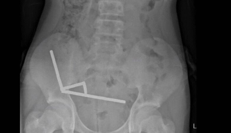 Young New Zealander swallowed 200 magnets. Didn't die