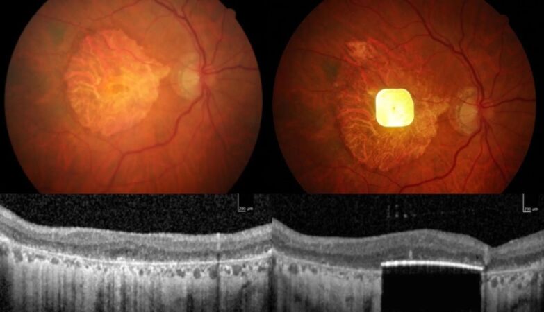 Tiny AI-assisted eye implant helps blind people see again