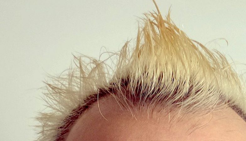 Natural sweetener can help treat baldness