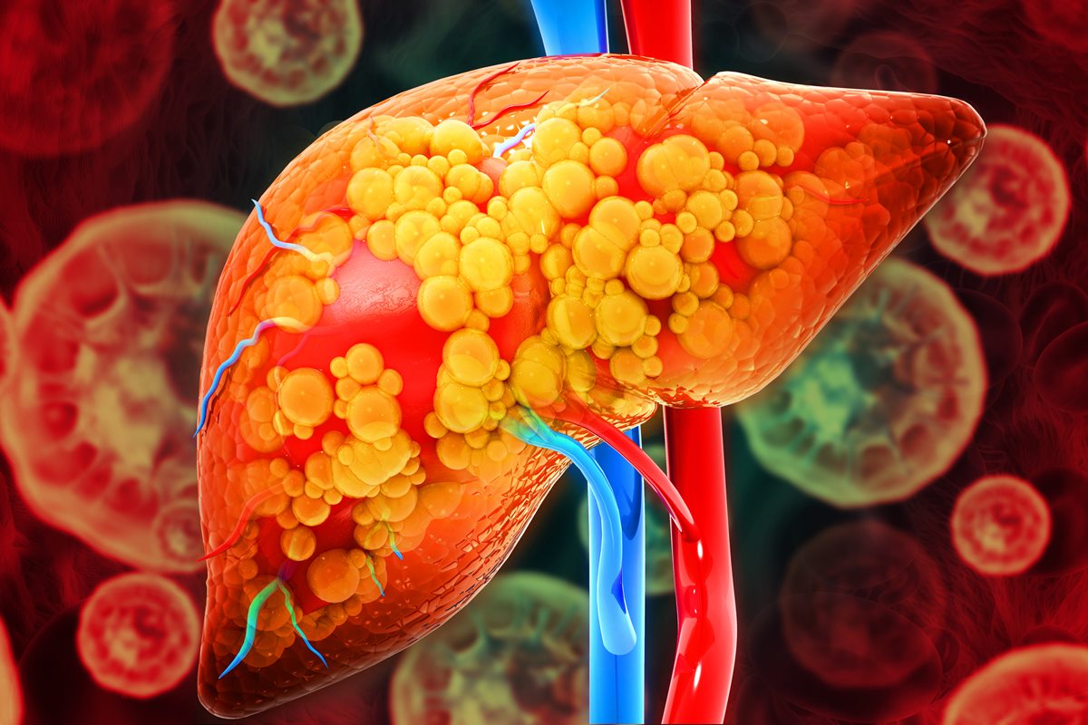 Colorful illustration of a fatty liver - What the liver really needs to function healthily - Metropolis