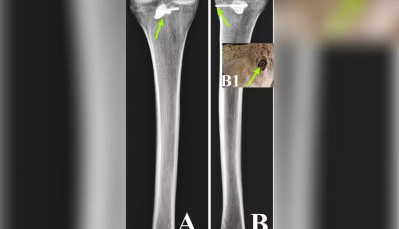 Struck by an arrow – which was never removed – he survived for some time. It was in the 3rd century