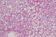 Microscopic view of cells in fatty liver, hepatic steatosis