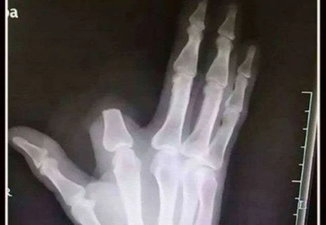Man cuts his own finger to contain snake venom and discovers it wasn't even poisonous