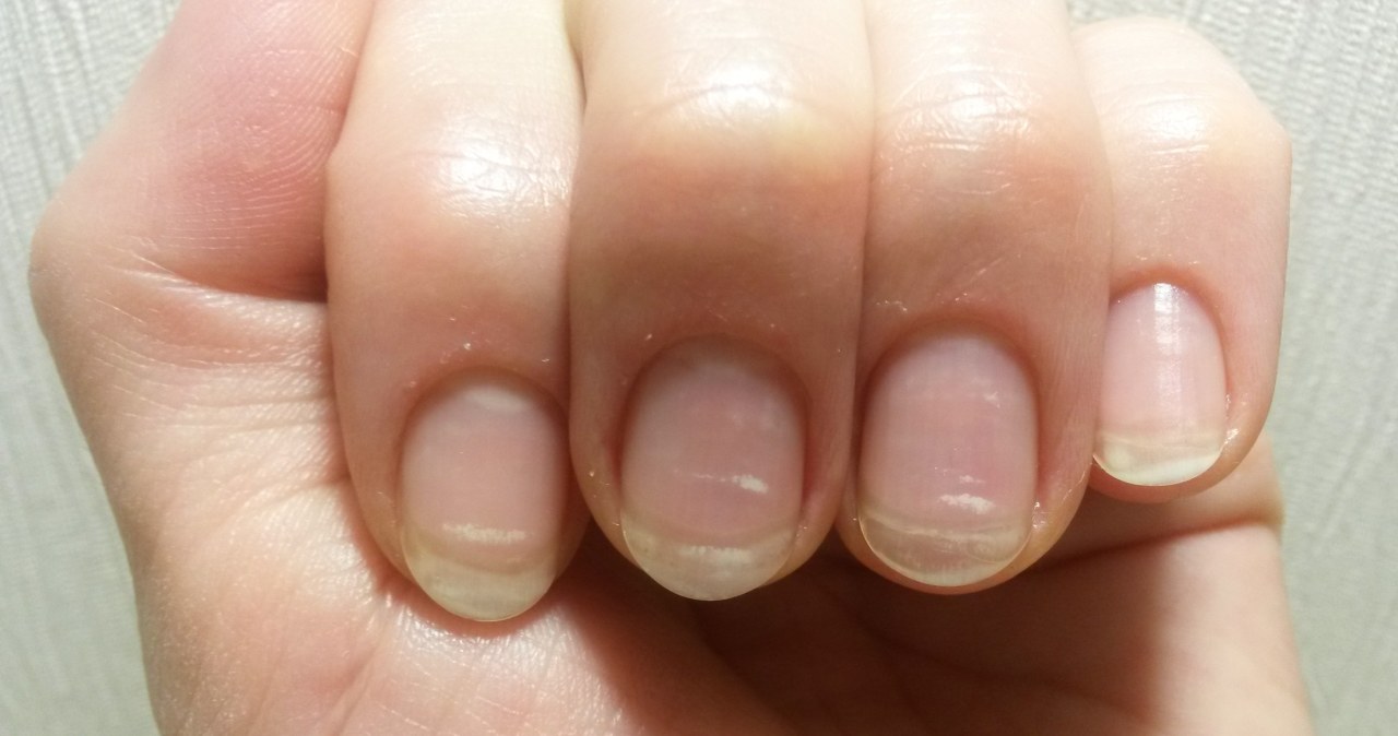 Take it from the kitchen and rub your nails. You will get rid of discolorations