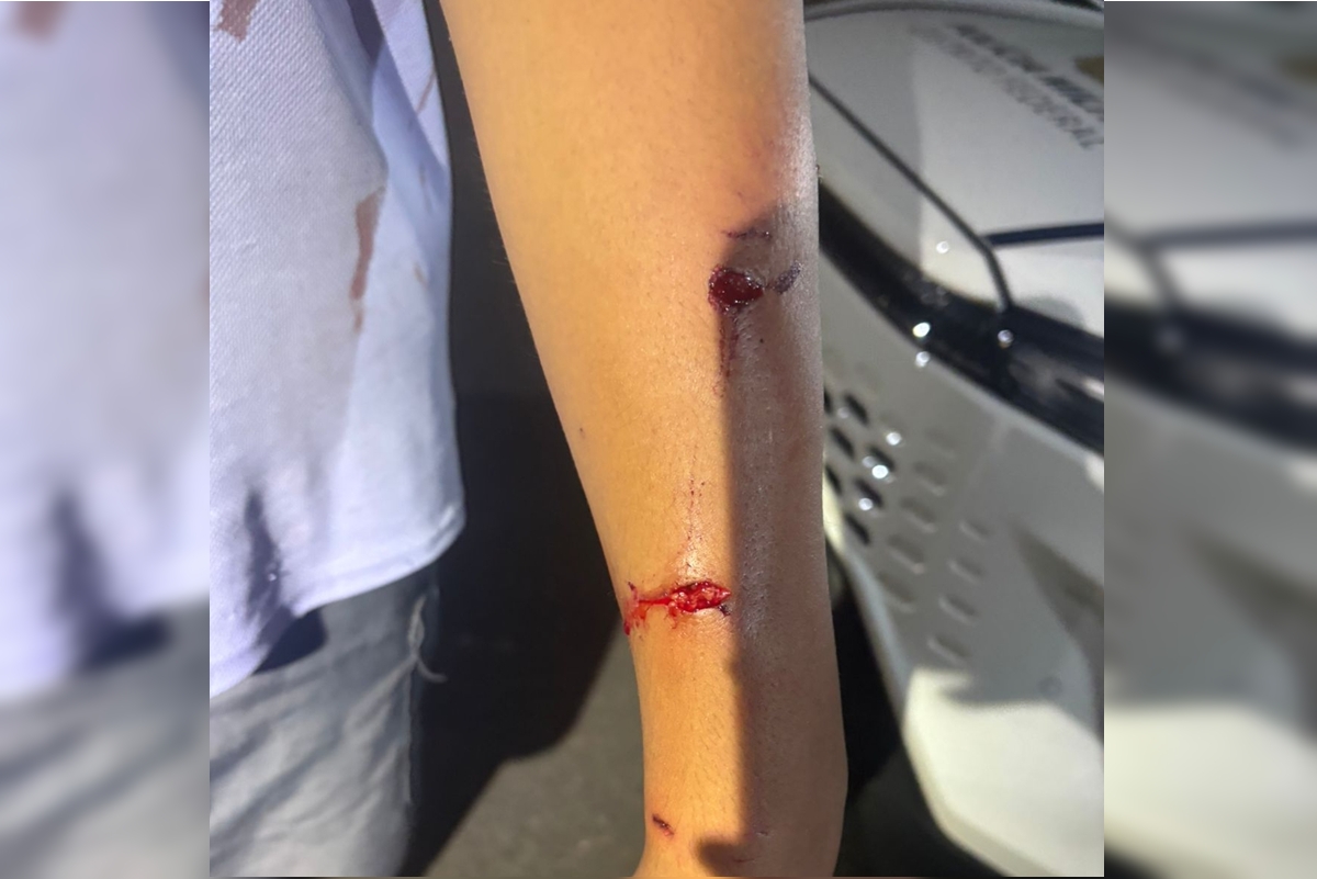 Boy was injured in the arm