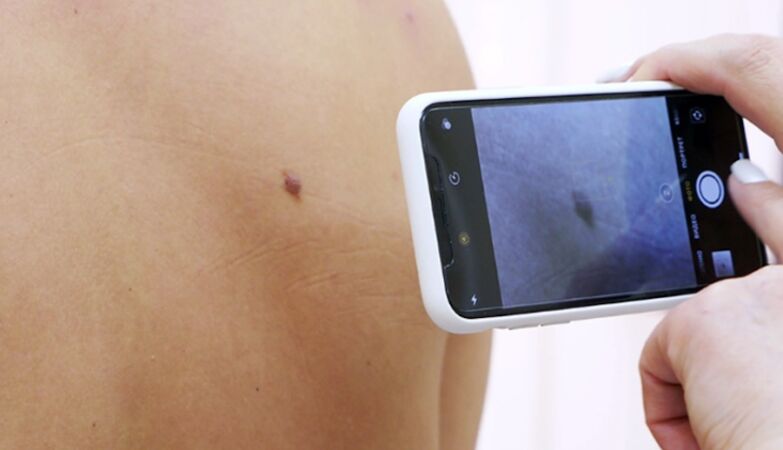 Skin cancer: Católica platform accelerates detection of the disease