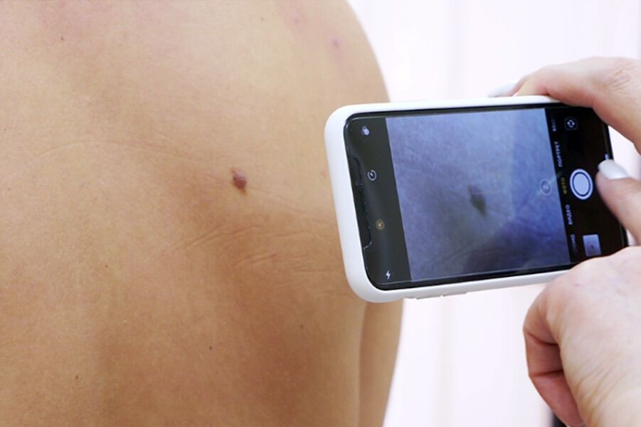 Skin cancer: Católica platform accelerates detection of the disease