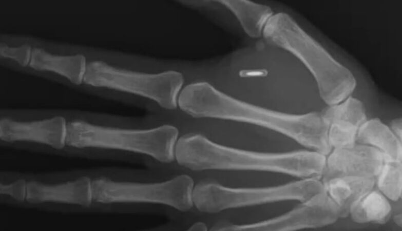 Mentalist implanted an RFID chip in his hand to perform tricks. But you forgot your password