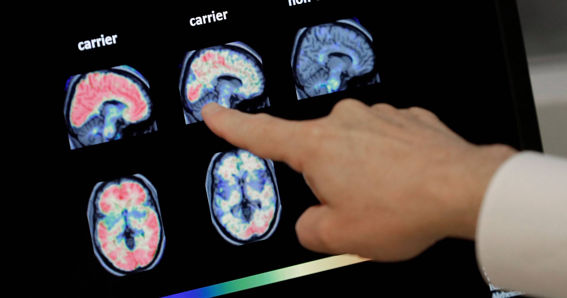 Menopause causes brain changes similar to Alzheimer's