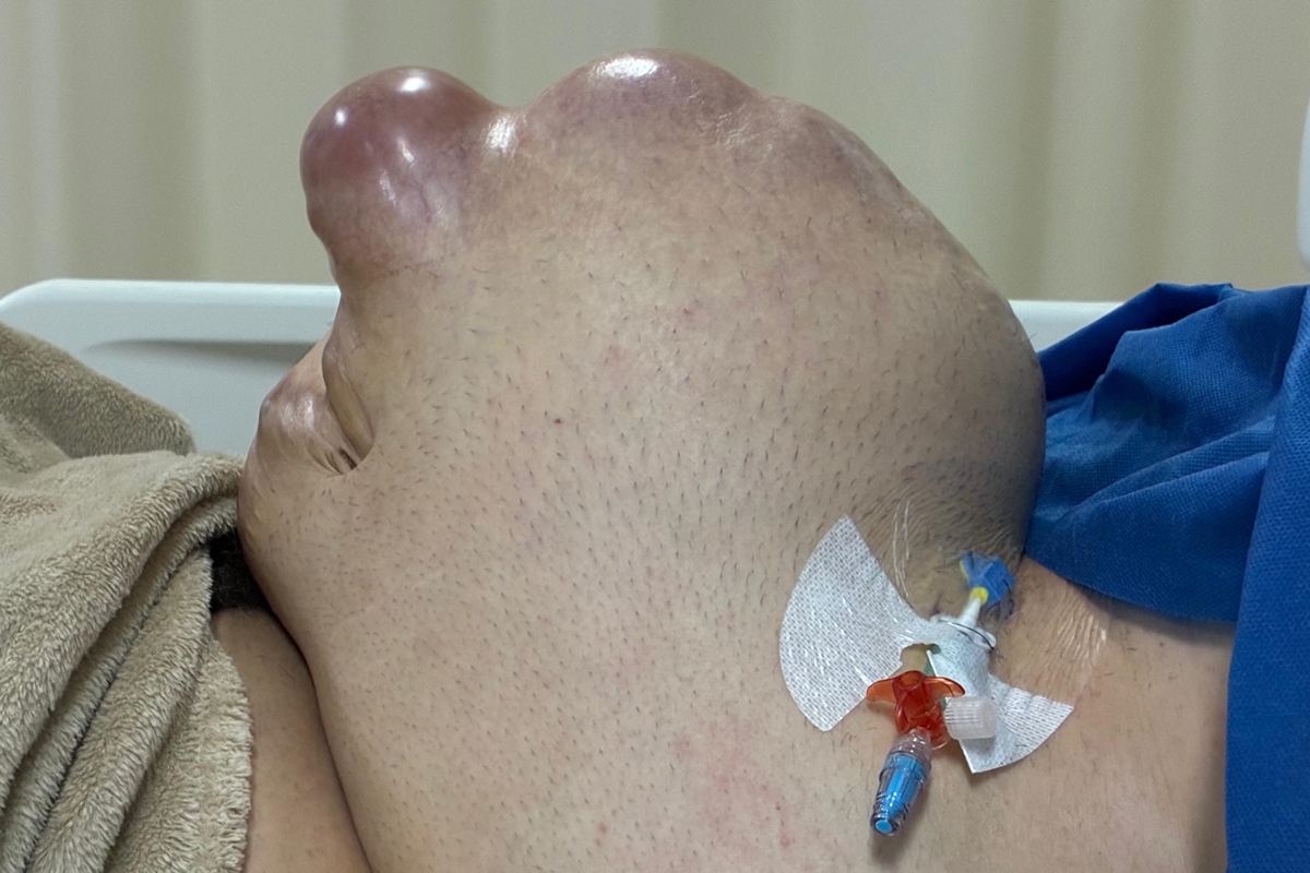 Color photo of giant hernia in the abdomen of a young man - Metrópoles. 