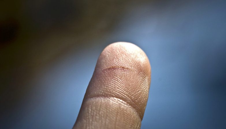 What is the best way to remove a splinter?
